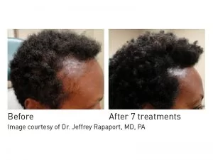 Hair Rejuvenation Before and After in Aurora, ON, Canada, by Dr Amber Bockneck