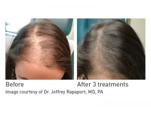 Hair Rejuvenation Before and After in Aurora, ON, Canada, by Dr Amber Bockneck