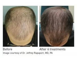 Hair Rejuvenation Before and After in Aurora, ON, Canada, by Dr Amber Bockneck