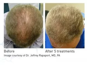 Hair Rejuvenation Before and After in Aurora, ON, Canada, by Dr Amber Bockneck