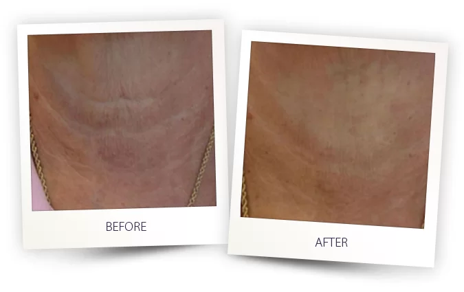 ClearLift Before and After in Aurora, ON, Canada, by Dr Amber Bockneck