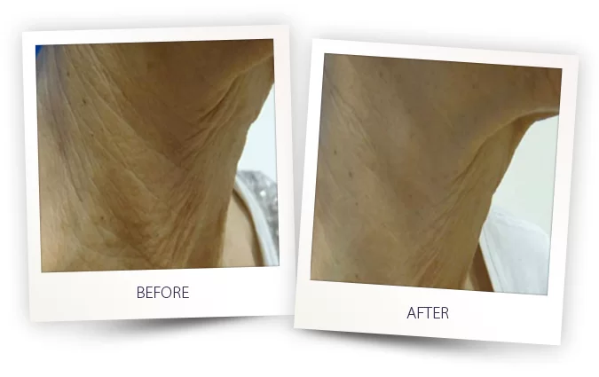 ClearLift Before and After in Aurora, ON, Canada, by Dr Amber Bockneck