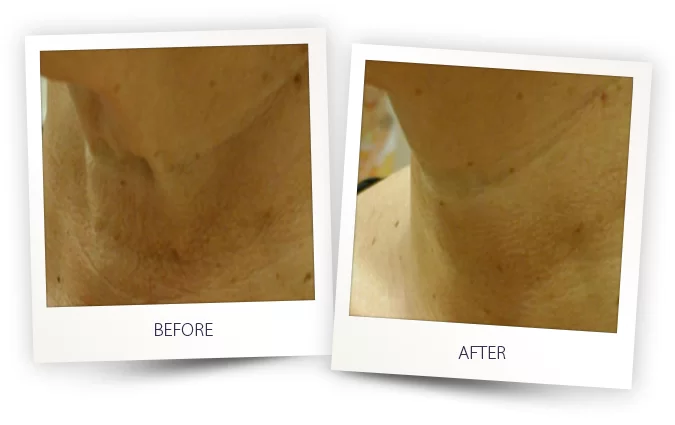 ClearLift Before and After in Aurora, ON, Canada, by Dr Amber Bockneck