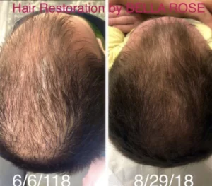 Hair Restoration Before and After in Aurora, ON, Canada, by Dr Amber Bockneck