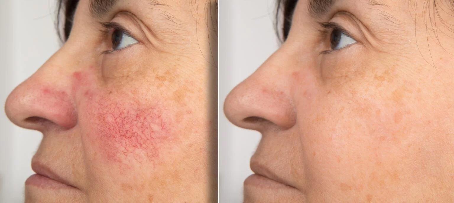 Flushing Rosacea Before and After in Aurora, ON, Canada, by Dr Amber Bockneck