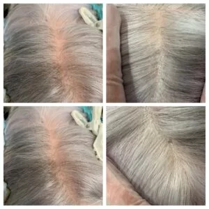 Hair Regrowth Before and After in Aurora, ON, Canada, by Dr Amber Bockneck