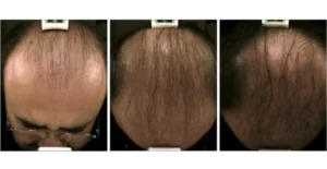 Hair Regrowth Before and After in Aurora, ON, Canada, by Dr Amber Bockneck