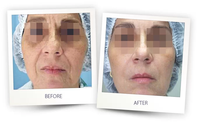 Aesthetics Treatment Before and After in Aurora, ON, Canada, by Dr Amber Bockneck