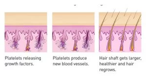 PRP/PRF Hair Rejuvenation in Aurora, ON, Canada, by Dr Amber Bockneck