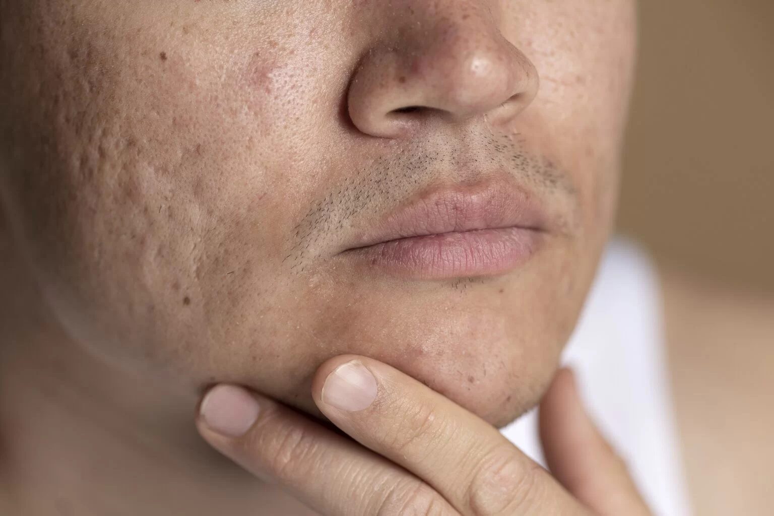 Acne Scarring in Aurora, ON, Canada, by Dr Amber Bockneck