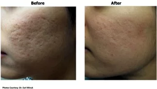 Cheek Before and After in Aurora, ON, Canada, by Dr Amber Bockneck
