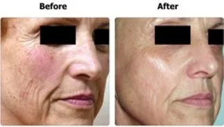 Face Treatment Before and After in Aurora, ON, Canada, by Dr Amber Bockneck