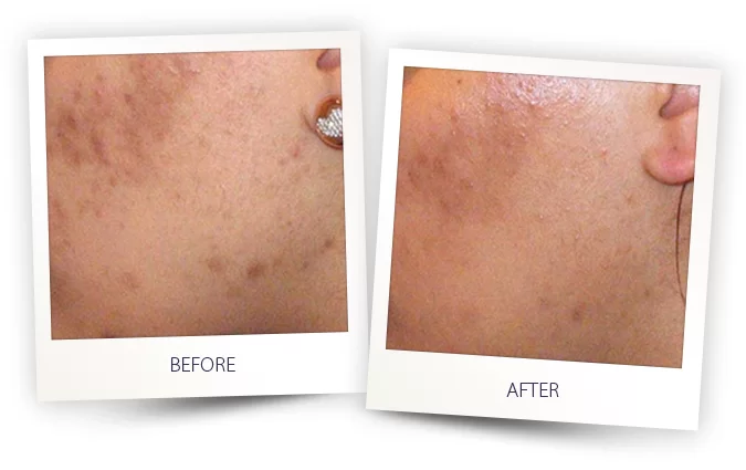 Aesthetics Treatment Before and After in Aurora, ON, Canada, by Dr Amber Bockneck