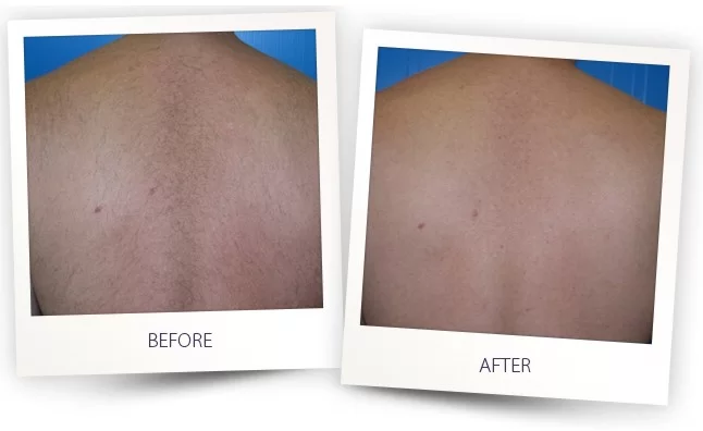 Laser Hair Removal Before and After in Aurora, ON, Canada, by Dr Amber Bockneck