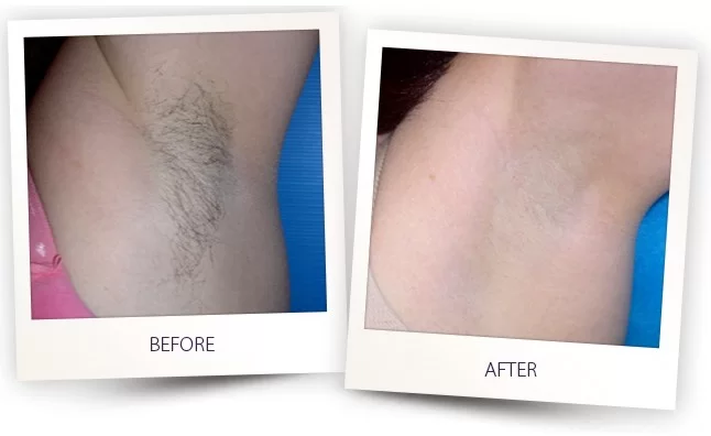 Laser Hair Removal Before and After in Aurora, ON, Canada, by Dr Amber Bockneck