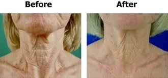 Neck Before and After in Aurora, ON, Canada, by Dr Amber Bockneck