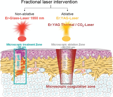 RF/CO2 Resurfacing in Aurora, ON, Canada, by Dr Amber Bockneck