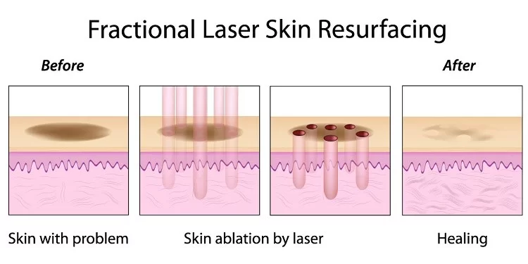 Fractional Laser Skin Resurfacing Before and After in Aurora, ON, Canada, by Dr Amber Bockneck