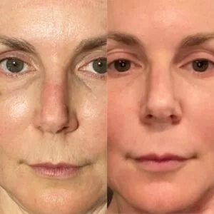 RF/CO2 Resurfacing Before and After in Aurora, ON, Canada, by Dr Amber Bockneck