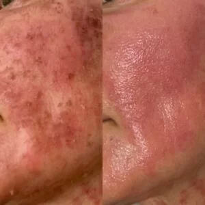 RF/CO2 Resurfacing Before and After in Aurora, ON, Canada, by Dr Amber Bockneck