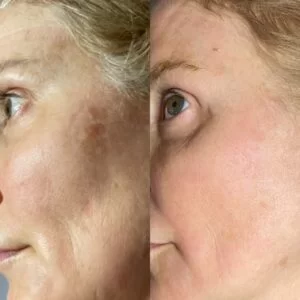 RF/CO2 Resurfacing Before and After in Aurora, ON, Canada, by Dr Amber Bockneck