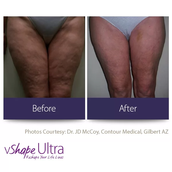 vShape Ultra Before and After in Aurora, ON, Canada, by Dr Amber Bockneck