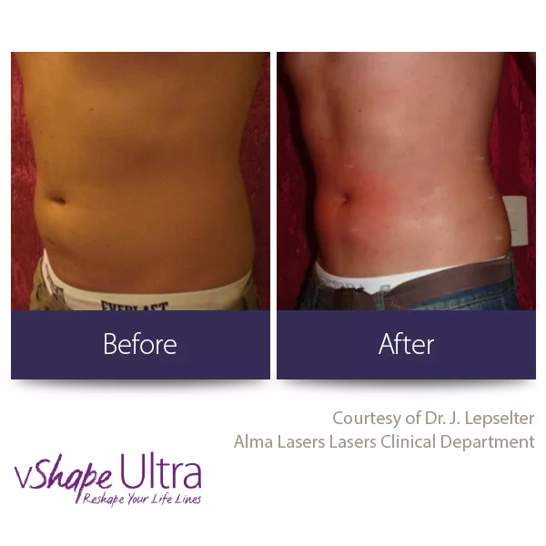 vShape Ultra Before and After in Aurora, ON, Canada, by Dr Amber Bockneck