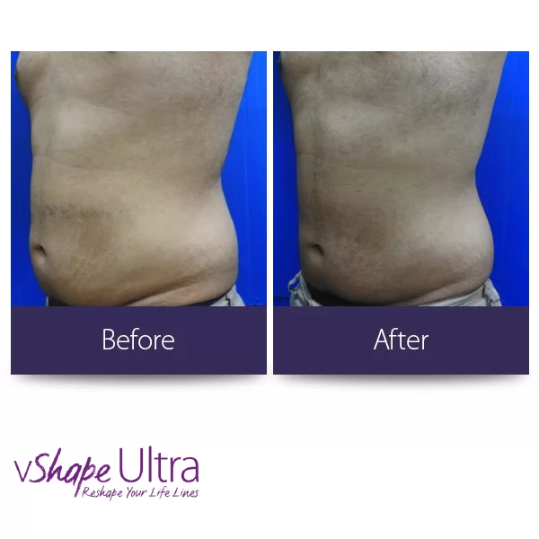 vShape Ultra Before and After in Aurora, ON, Canada, by Dr Amber Bockneck