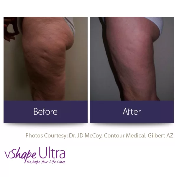 vShape Ultra Before and After in Aurora, ON, Canada, by Dr Amber Bockneck