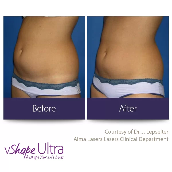 vShape Ultra Before and After in Aurora, ON, Canada, by Dr Amber Bockneck