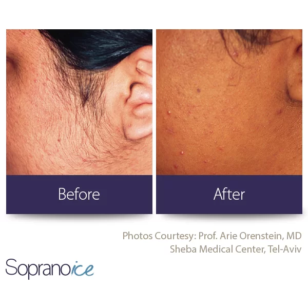 Laser Hair Removal Before and After in Aurora, ON, Canada, by Dr Amber Bockneck