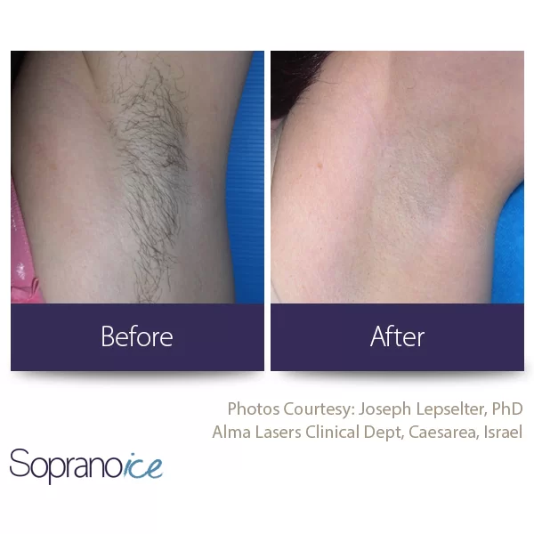 Laser Hair Removal Before and After in Aurora, ON, Canada, by Dr Amber Bockneck